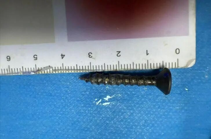 安徽3岁幼童紧急就医!医生:很危险,处理不当可危及生命 安徽3岁幼童紧急就医!医生:很危险,处理不当可危及生命