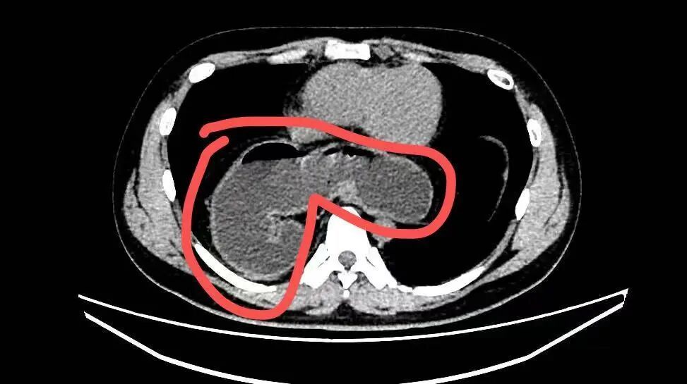 28岁小伙总是嗳气烧心，没想到是半个胃“钻”到了胸腔里