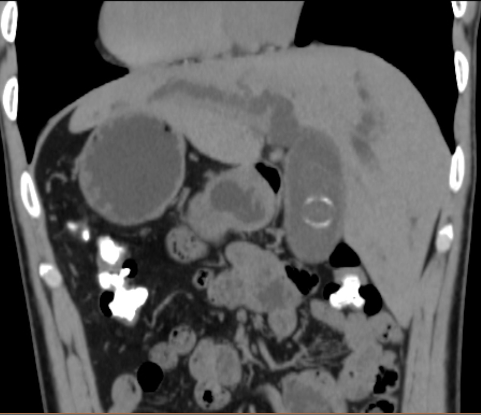 五脏六腑全长反了！“镜面人”长了结石，咋办？