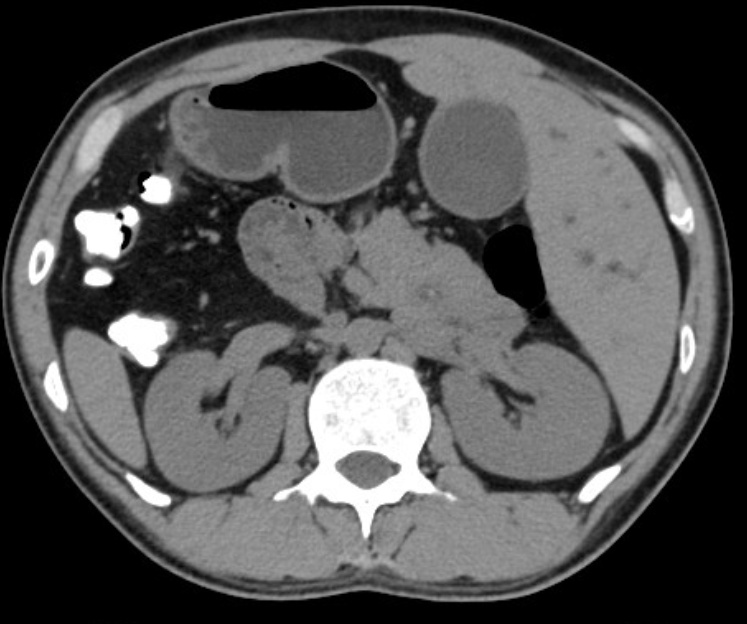 五脏六腑全长反了！“镜面人”长了结石，咋办？