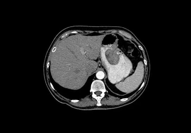 6种常见饮食与癌症发生发展有关,很多人每天都在吃 6种常见饮食与癌症发生发展有关,很多人每天都在吃