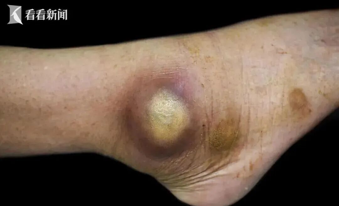 女子帮亲戚按摩治病!致其血液感染后死亡!法院判了 女子帮亲戚按摩治病!致其血液感染后死亡!法院判了