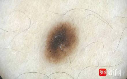 大爷眼角小痣不停抠 半张脸烂了