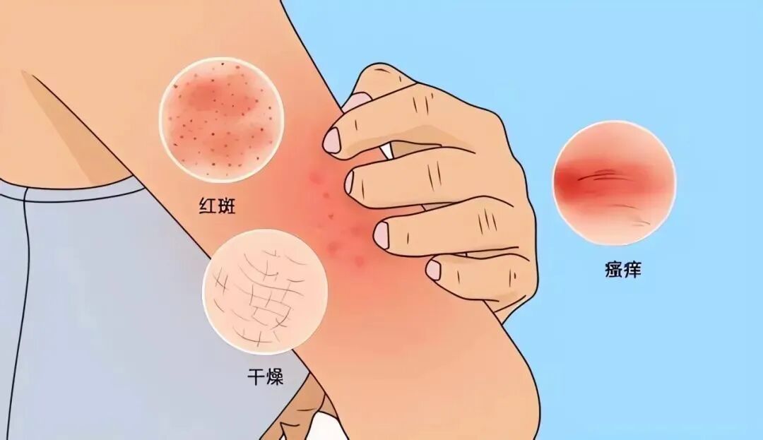 冬天皮肤会“闹小脾气”? 冬天皮肤会“闹小脾气”?