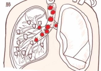 得结节的人越来越多？有这个特点的人可能是结节体质