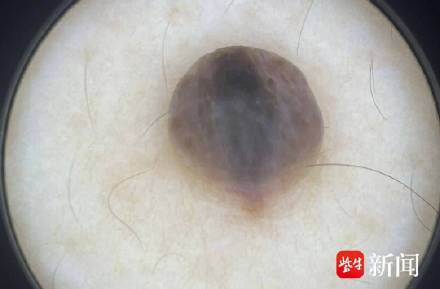 大爷眼角小痣不停抠 半张脸烂了