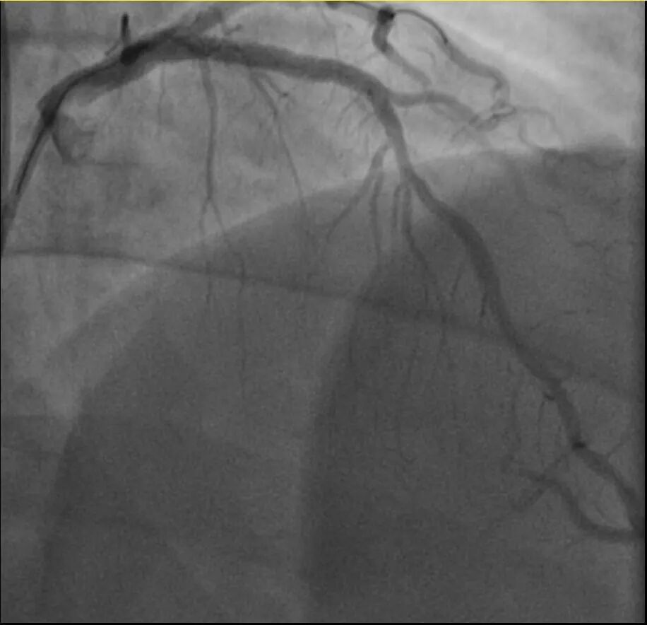 一天内，杭州两位38岁宝爸运动后倒下！医生：这些都是导火索！