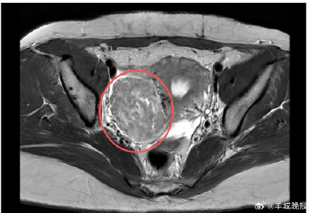 女子八年未复查子宫肌瘤大如拳头