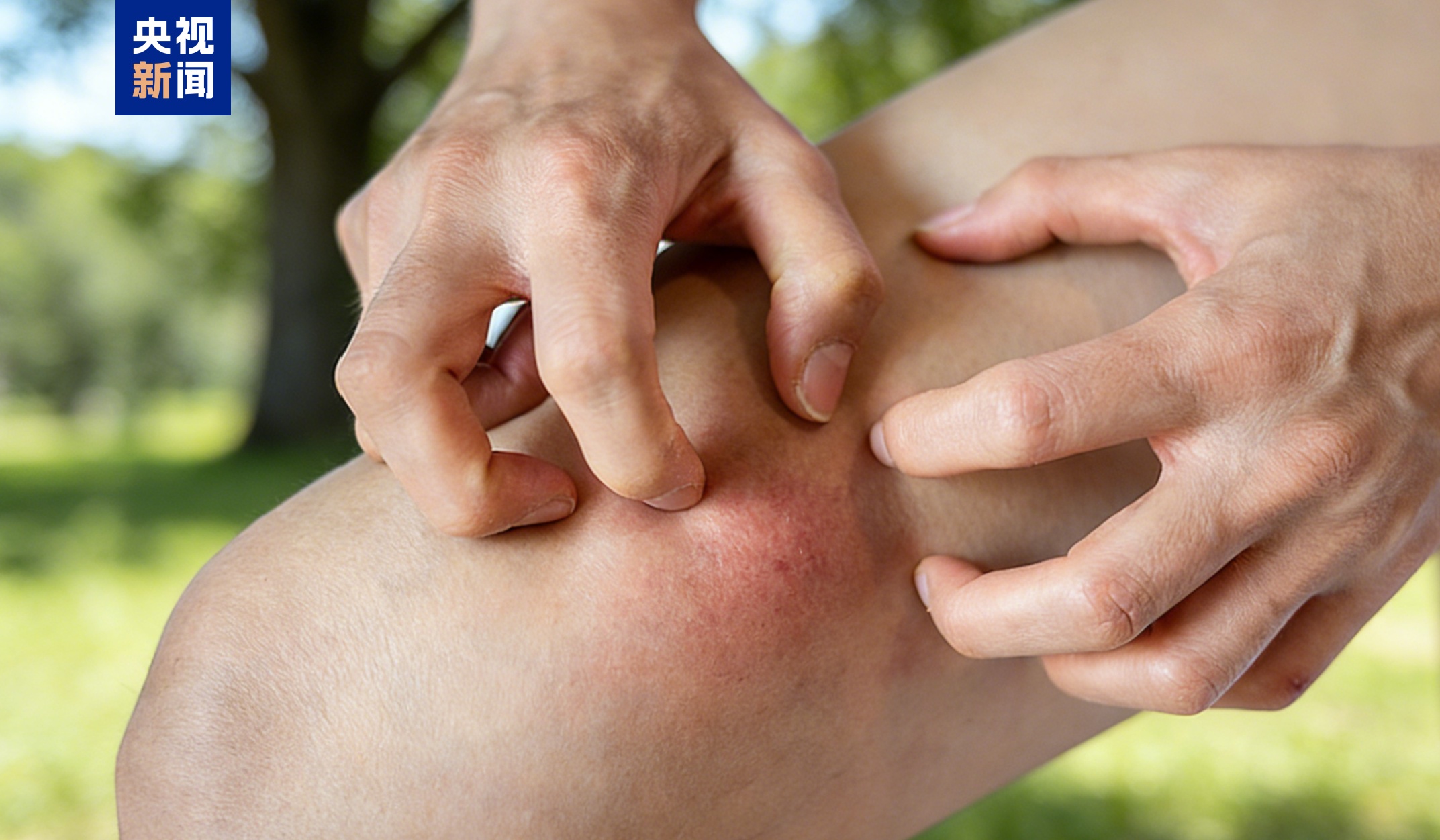 湿疹可能是“干”出来的 冬季皮肤瘙痒需警惕