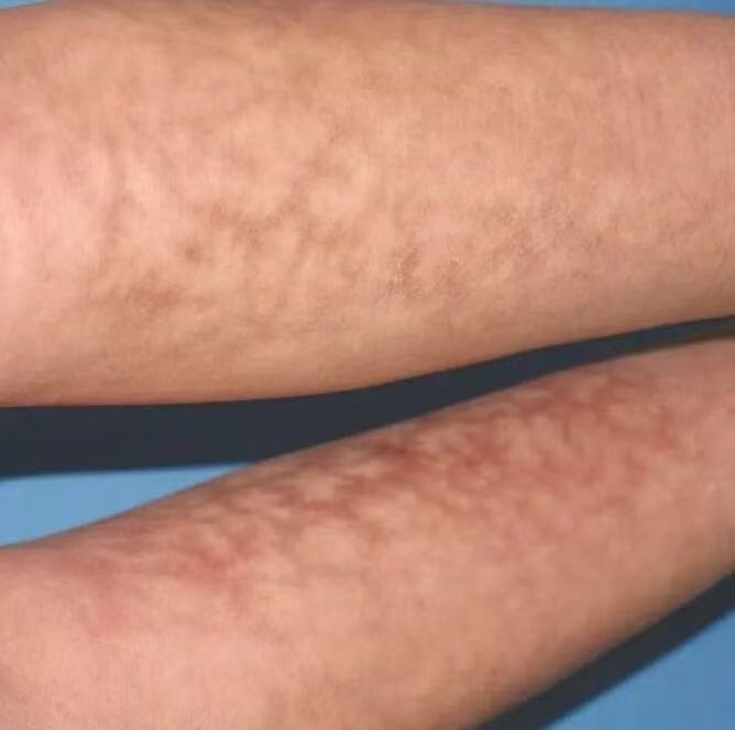 小伙双腿长出“蟒蛇纹”!近期很多人这么做,尤其是睡觉…… 小伙双腿长出“蟒蛇纹”!近期很多人这么做,尤其是睡觉……