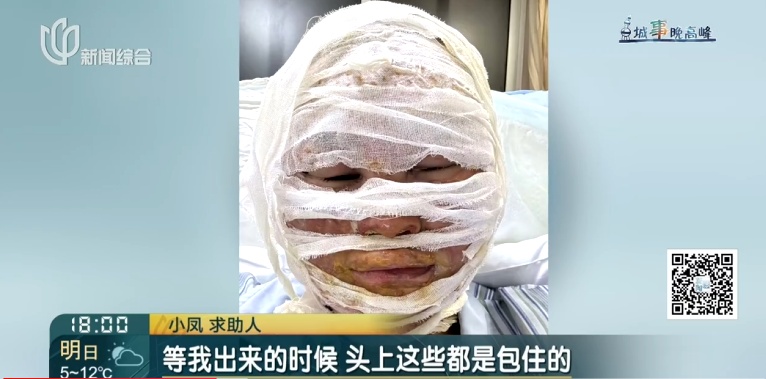 上海一美容院酒精突然爆炸!女子深度烧伤,巨额治疗费无着落… 上海一美容院酒精突然爆炸!女子深度烧伤,巨额治疗费无着落…