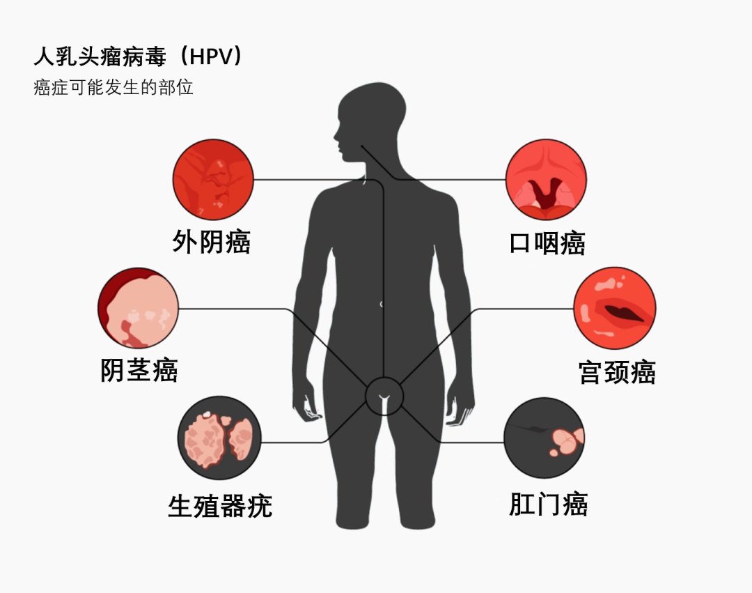 浙江男子嘴巴里长“菜花”,确诊HPV还有癌症中晚期!这个夫妻亲密习惯是诱因 浙江男子嘴巴里长“菜花”,确诊HPV还有癌症中晚期!这个夫妻亲密习惯是诱因