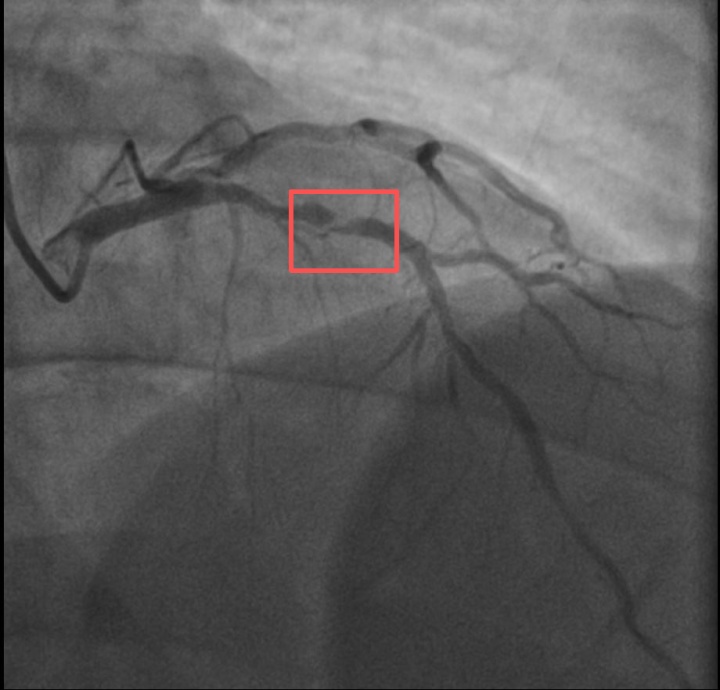 一天内，两位38岁宝爸带娃时倒下，送医抢救！医生：高危人群不要"上强度"