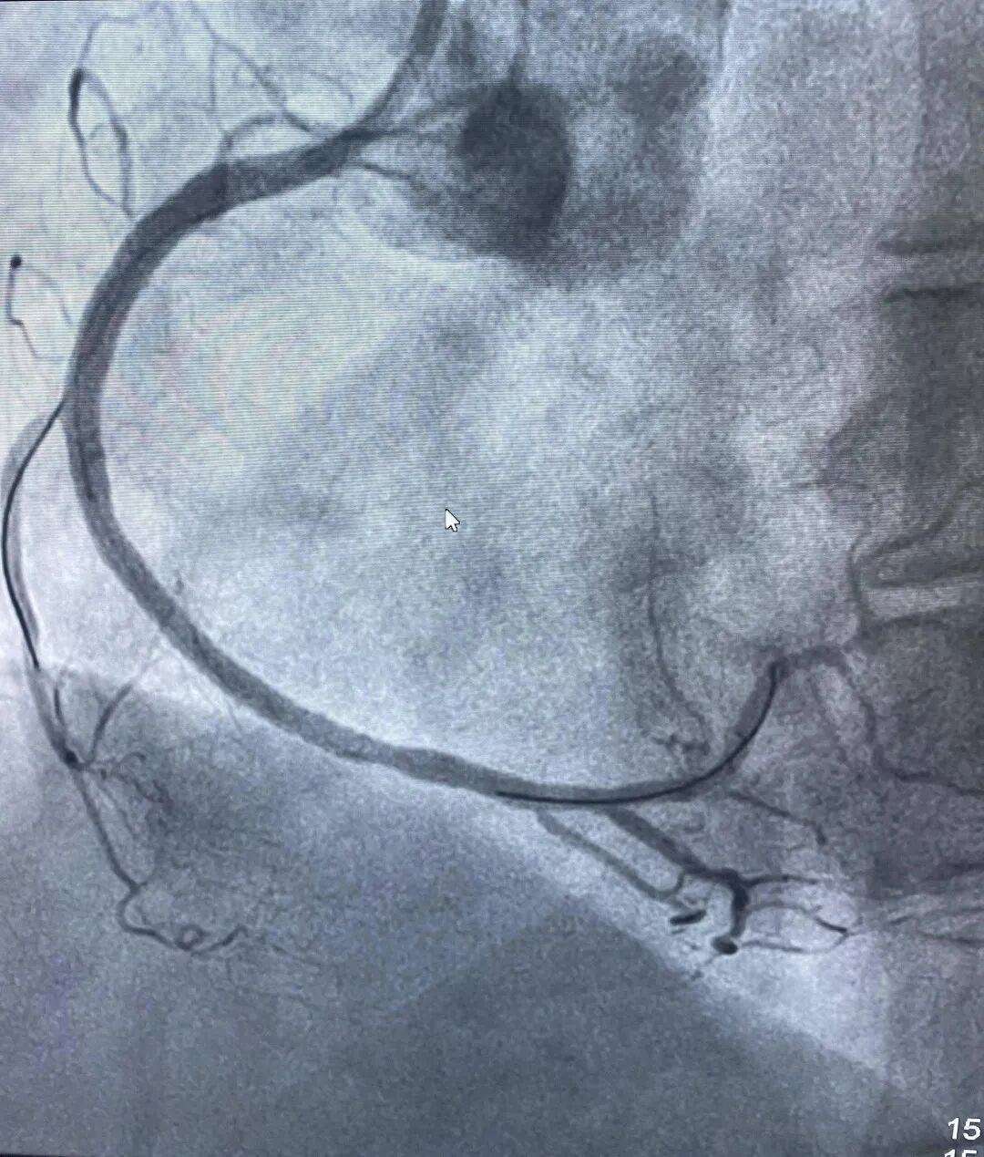 情况危急!女子旅游时突发心梗,医生:需格外注意 情况危急!女子旅游时突发心梗,医生:需格外注意