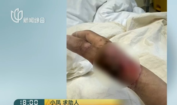 上海一美容院酒精突然爆炸!女子深度烧伤,巨额治疗费无着落… 上海一美容院酒精突然爆炸!女子深度烧伤,巨额治疗费无着落…