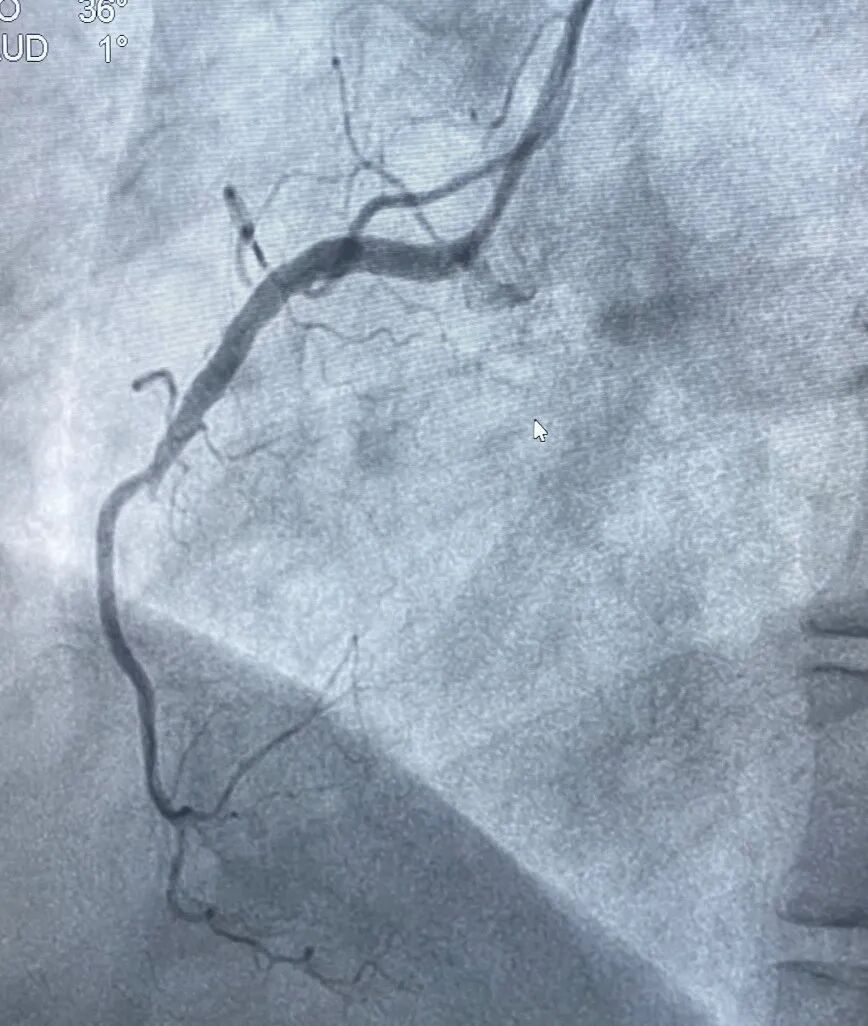 情况危急!女子旅游时突发心梗,医生:需格外注意 情况危急!女子旅游时突发心梗,医生:需格外注意