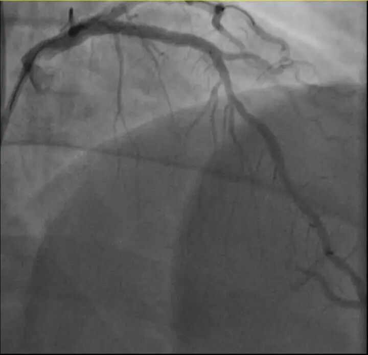 一天内，两位38岁宝爸带娃时倒下，送医抢救！医生：高危人群不要"上强度"