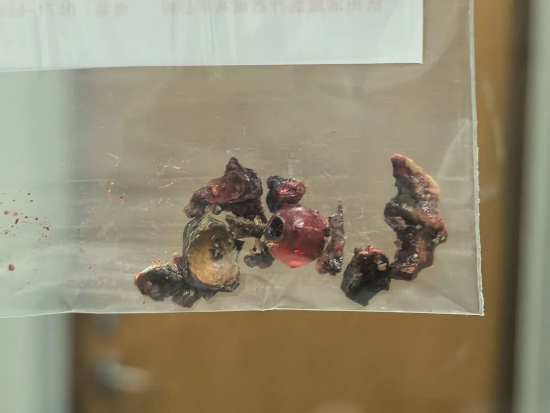 十几年“鼻窦炎”总不好? 医生一查:“元凶”竟是它! 十几年“鼻窦炎”总不好? 医生一查:“元凶”竟是它!