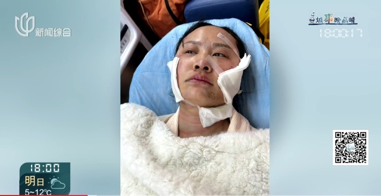 上海一美容院酒精突然爆炸!女子深度烧伤,巨额治疗费无着落… 上海一美容院酒精突然爆炸!女子深度烧伤,巨额治疗费无着落…