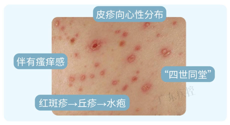 广东疾控提醒:水痘正处于活跃期!传染性极高!赶紧做好这件事 广东疾控提醒:水痘正处于活跃期!传染性极高!赶紧做好这件事