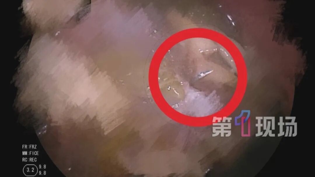 11岁男孩吸管“发射”大头针，一不小心吸胃里去了…