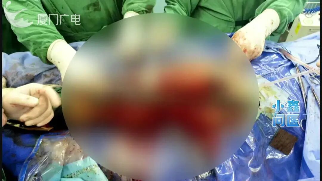 “断骨重生”!一男子遭遇意外粉碎性骨折,治疗800多天,竟长出15.75厘米骨头 “断骨重生”!一男子遭遇意外粉碎性骨折,治疗800多天,竟长出15.75厘米骨头