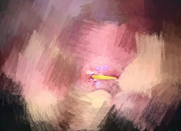 上海爷叔遭罪了！甲鱼骨头刺穿小肠！这种吃饭习惯请注意