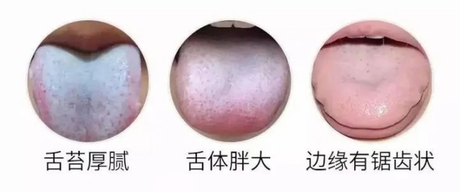 舌头有齿痕,说明这个脏器“虚透”了 舌头有齿痕,说明这个脏器“虚透”了