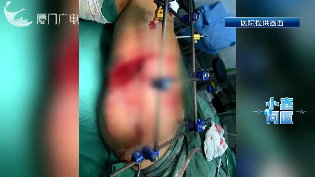 “断骨重生”!一男子遭遇意外粉碎性骨折,治疗800多天,竟长出15.75厘米骨头 “断骨重生”!一男子遭遇意外粉碎性骨折,治疗800多天,竟长出15.75厘米骨头
