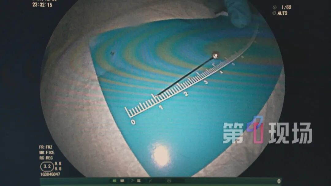 11岁男孩吸管“发射”大头针，一不小心吸胃里去了…