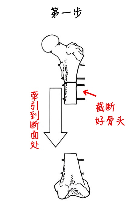 “断骨重生”!一男子遭遇意外粉碎性骨折,治疗800多天,竟长出15.75厘米骨头 “断骨重生”!一男子遭遇意外粉碎性骨折,治疗800多天,竟长出15.75厘米骨头