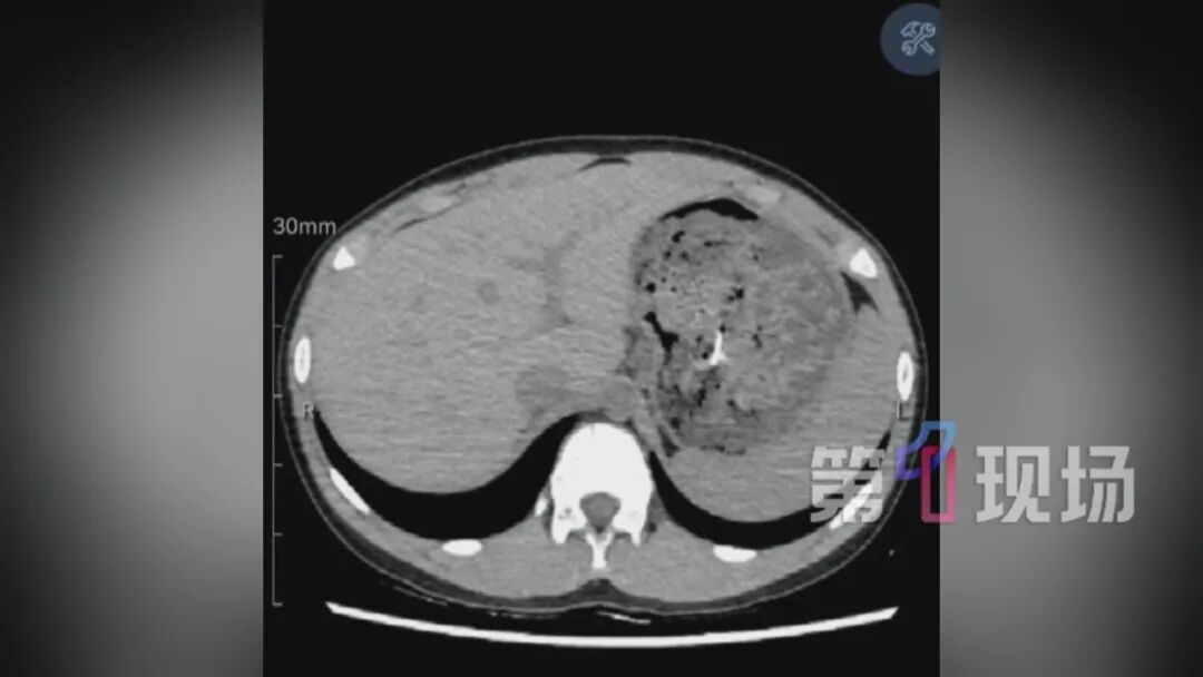 11岁男孩吸管“发射”大头针，一不小心吸胃里去了…