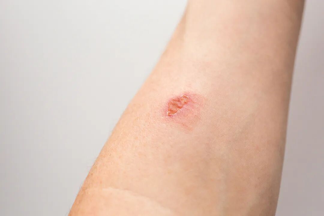 红霉素软膏千万不能随便用！赶紧告诉家里人