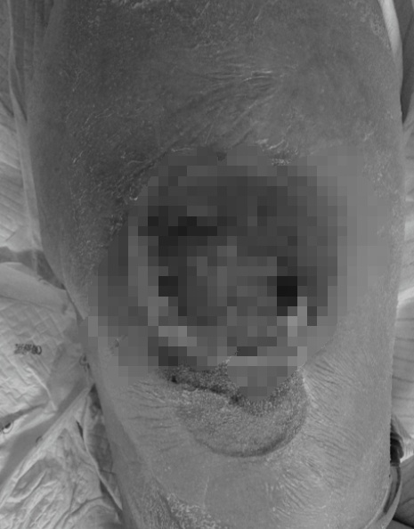 深圳一中年男子自行拔火罐，被送进ICU两次！