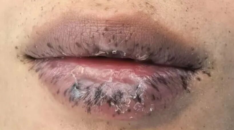 嘴唇出现这种变化,竟是体内有癌!33岁李先生确诊了 嘴唇出现这种变化,竟是体内有癌!33岁李先生确诊了