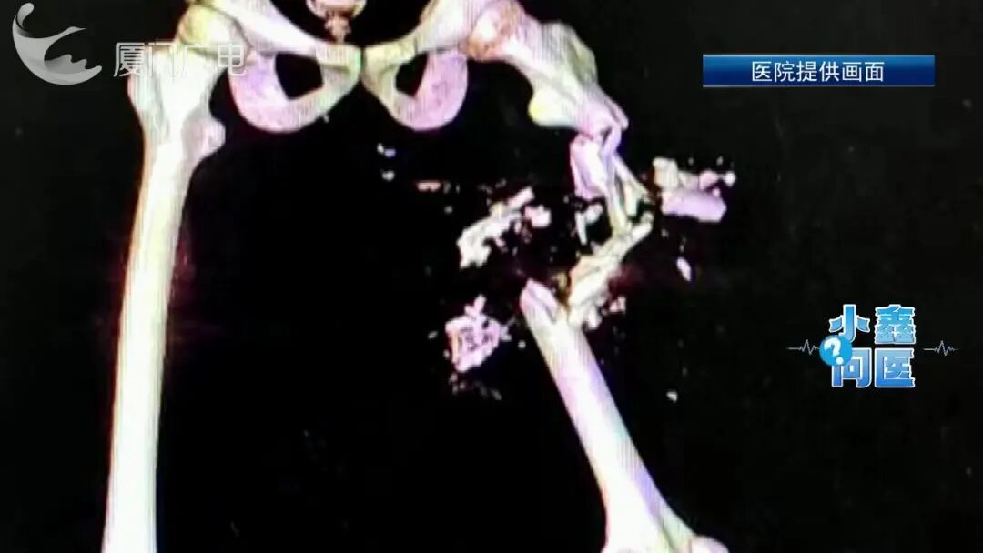 “断骨重生”!一男子遭遇意外粉碎性骨折,治疗800多天,竟长出15.75厘米骨头 “断骨重生”!一男子遭遇意外粉碎性骨折,治疗800多天,竟长出15.75厘米骨头