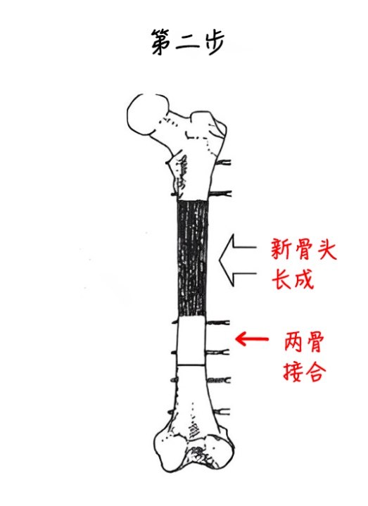 “断骨重生”!一男子遭遇意外粉碎性骨折,治疗800多天,竟长出15.75厘米骨头 “断骨重生”!一男子遭遇意外粉碎性骨折,治疗800多天,竟长出15.75厘米骨头
