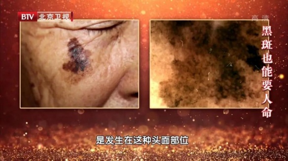 30岁之后出现的这种痣，恶变几率越高