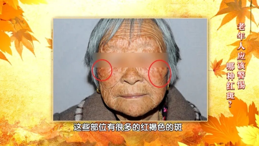 30岁之后出现的这种痣，恶变几率越高