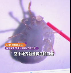 郑州4岁男童海南旅游回家，妈妈在眼睑上看到小黑点，医生吓坏了：蜱虫！