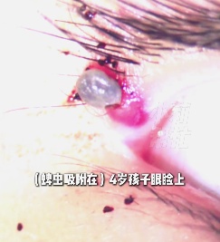 郑州4岁男童海南旅游回家，妈妈在眼睑上看到小黑点，医生吓坏了：蜱虫！