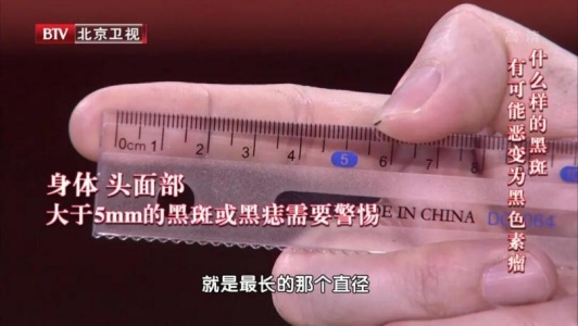 30岁之后出现的这种痣，恶变几率越高