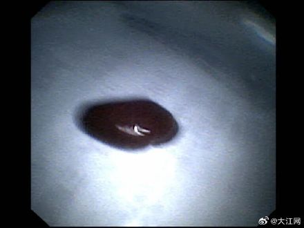 吓人!赣州一男子喝山涧溪水 长约6.5cm蚂蟥竟“住”进身体 吓人!赣州一男子喝山涧溪水 长约6.5cm蚂蟥竟“住”进身体