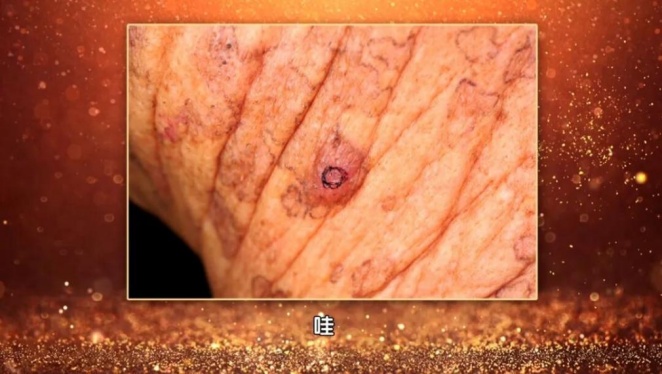 30岁之后出现的这种痣，恶变几率越高