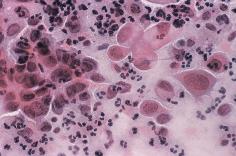 抓住HPV疫苗接种的“黄金”时机 让病毒“无处可逃” 抓住HPV疫苗接种的“黄金”时机 让病毒“无处可逃”