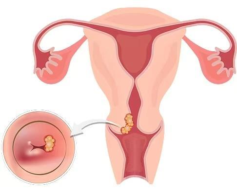 抓住HPV疫苗接种的“黄金”时机 让病毒“无处可逃” 抓住HPV疫苗接种的“黄金”时机 让病毒“无处可逃”