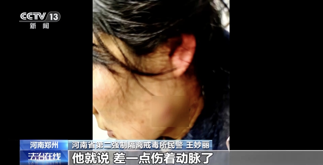 女警徒手夺刀,脸上缝30多针:“后怕但不后悔!” 女警徒手夺刀,脸上缝30多针:“后怕但不后悔!”