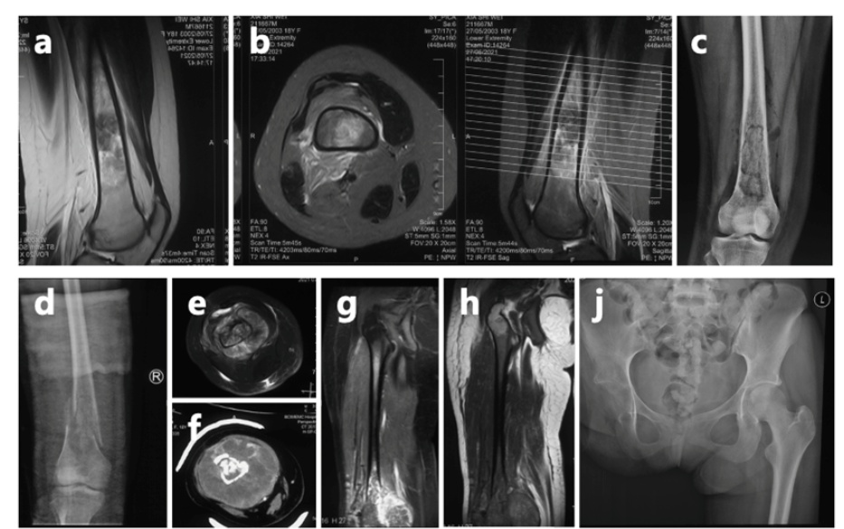 23岁在沪女孩命运揪心！自己签字6次手术，截肢后双亲断联...上海专家全力救治