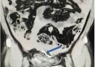 男子打拳下腹部被击中，晚上聚餐饮酒无法排尿，确诊膀胱破裂