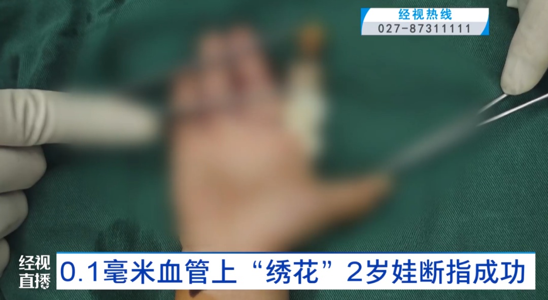 2岁男童手指被机器切断，医生用25倍显微镜和最细的缝线在0.1毫米级的血管上“绣花”